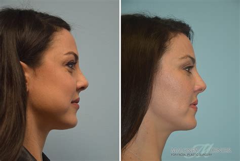 buccal fat pad removal stockholm|Buccal Fat Pad Reduction .